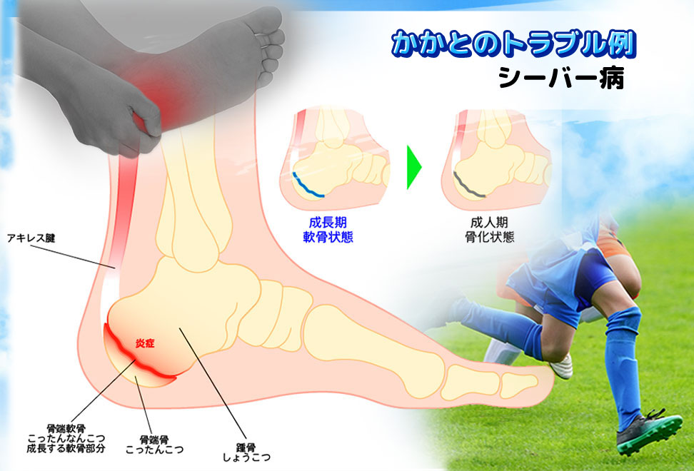 かかとのトラブル　シーバー病