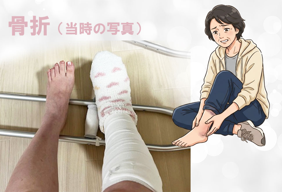 アヤメさんが実際に骨折した時の画像です。
